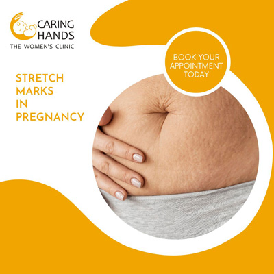 Stretch Marks in Pregnancy-Everything You Should Know